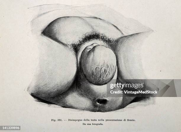 Medical drawing from Trattato Completo di Ostetricia illustrates birth, 1905.