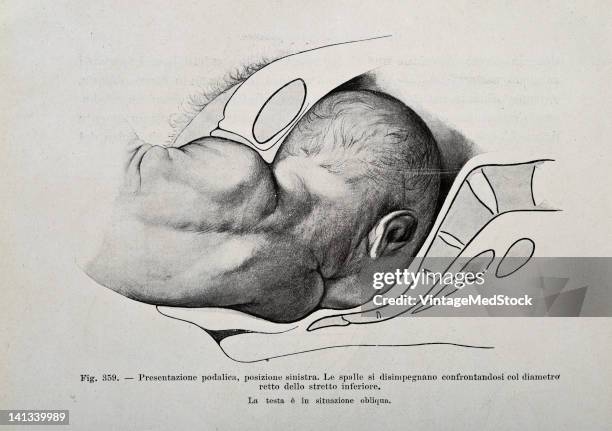 Medical drawing from Trattato Completo di Ostetricia illustrates a baby moving through the birth canal, 1905.