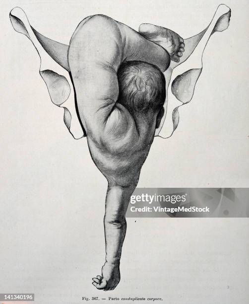 Medical drawing from Trattato Completo di Ostetricia illustrates a baby moving through the birth canal, 1905.