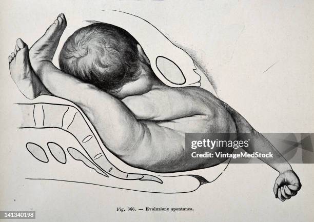 Medical drawing from Trattato Completo di Ostetricia illustrates a human fetus moving through the birth canal, 1905.