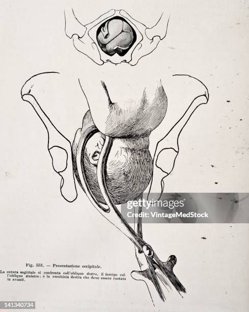 Medical drawing from Trattato Completo di Ostetricia illustrates assisted birth, 1905.