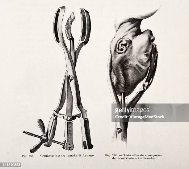 Medical drawing from Trattato Completo di Ostetricia of the 3-branch auvard with an illustration of how to use it, 1905.