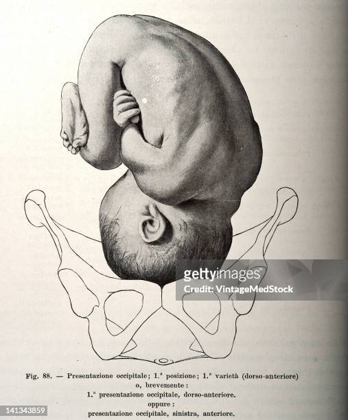 Medical drawing from Trattato Completo di Ostetricia illustrates the fetal attitude in relation to the hip bone, 1905.