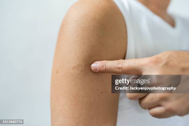 monkeypox and smallpox vaccine scar on human's arm - smallpox epidemic stock pictures, royalty-free photos & images