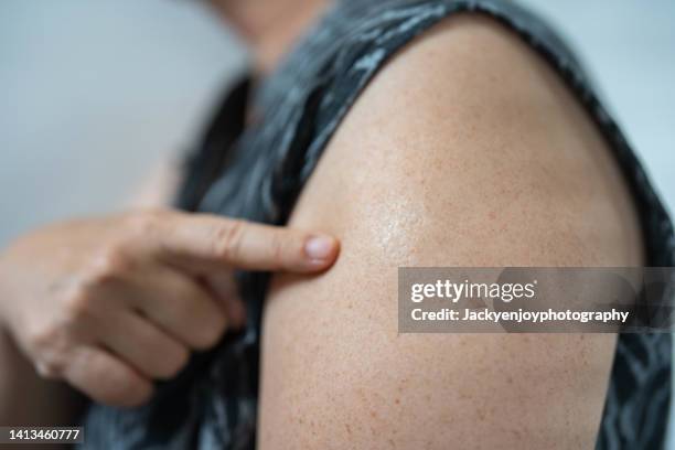 monkeypox and smallpox vaccine scar on human's arm - smallpox scars stock pictures, royalty-free photos & images