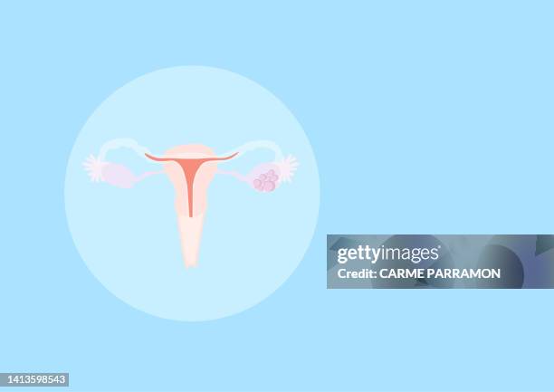 bildbanksillustrationer, clip art samt tecknat material och ikoner med ovarian cancer - cyst