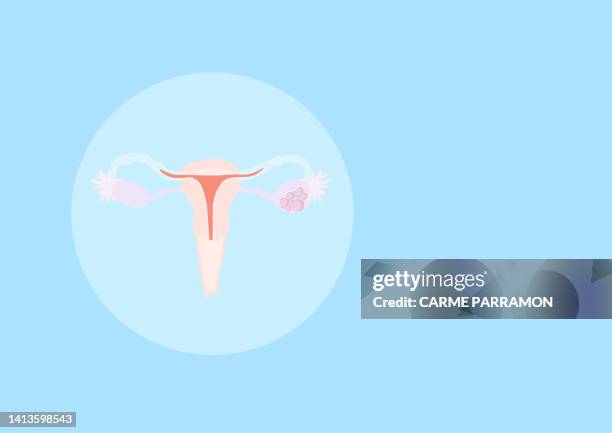 ovarian cancer - ovarian cyst stock illustrations