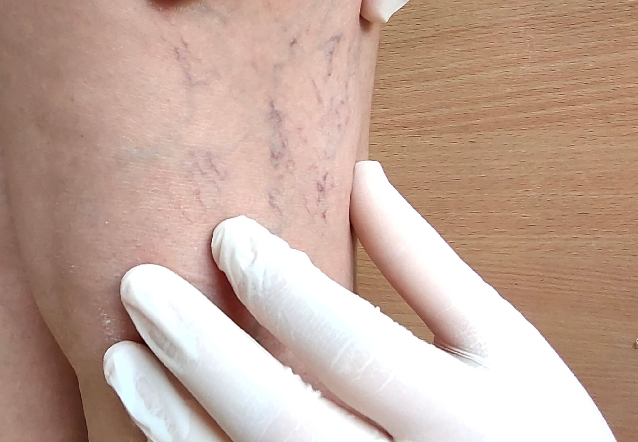 tratamento veias
