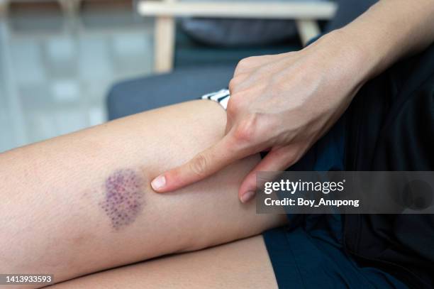 close up of bruise occur on woman leg. bruising can occur more easily as we age due to thinning of the skin. - prellung stock-fotos und bilder