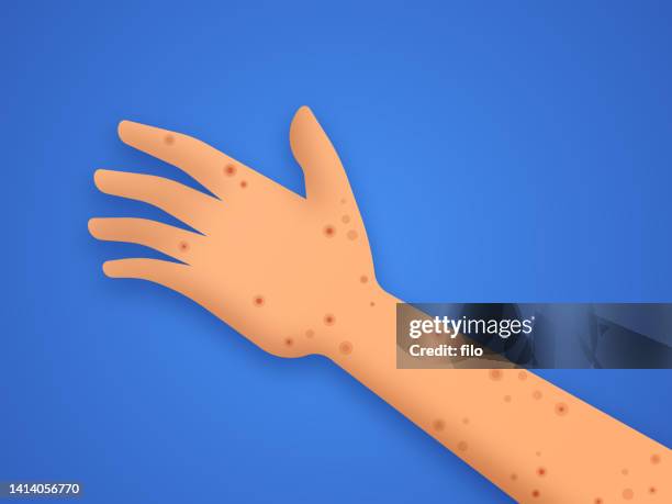 monkeypox illness human arm - pathogen transmission 幅插畫檔、美工圖案、卡通及圖標