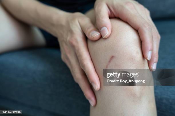 cropped shot of woman having scar and scratched on her leg. - cicatriz imagens e fotografias de stock