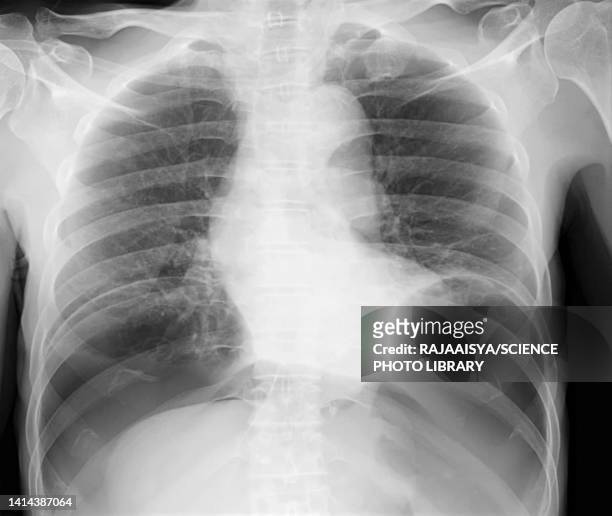 pneumoperitoneum, x-ray - rib cage ストックフォトと画像