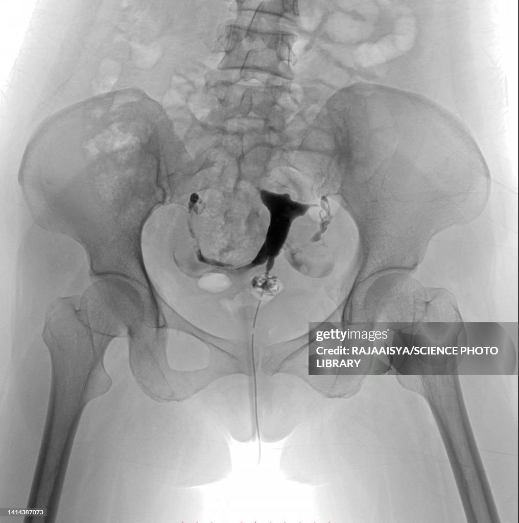 Fallopian Tube Clips Radiology Fallopian Tube Of A Patient With Infertility Xray High-Res Stock Photo ...