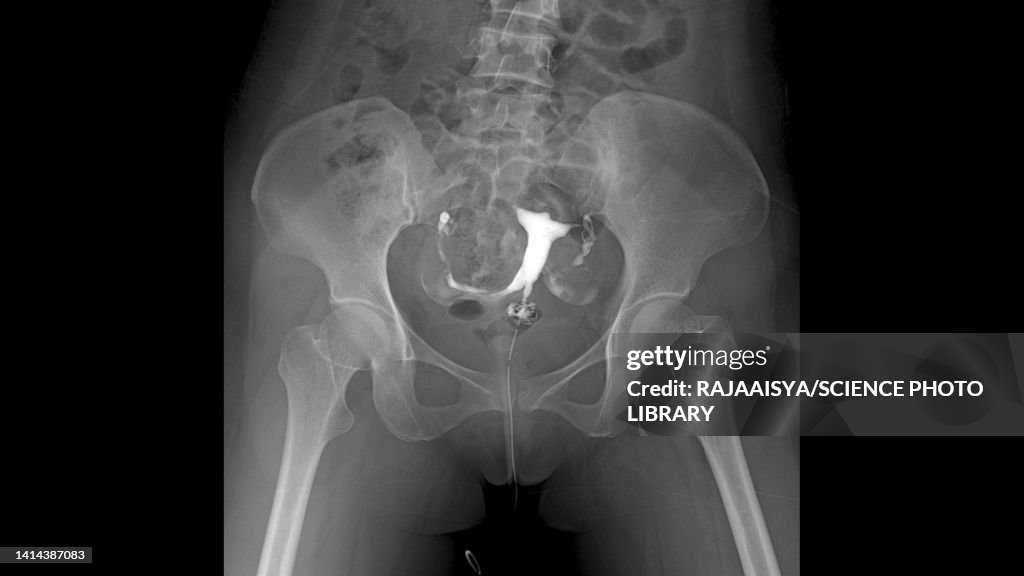 Fallopian Tube Clips Radiology Fallopian Tube Of A Patient With Infertility Xray High-Res Stock Photo ...