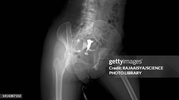 fallopian tube of a patient with infertility, x-ray - genitalien stockfoto's en -beelden