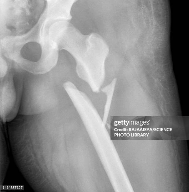 fractured femur, x-ray - femur stock-fotos und bilder