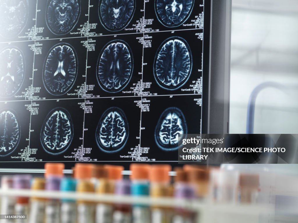 Alzheimer's and dementia research, conceptual image