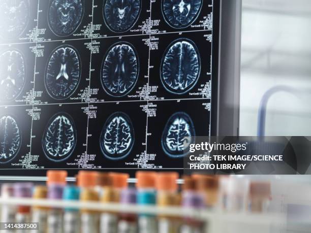 Alzheimers And Dementia Research Conceptual Image High-Res Stock Photo