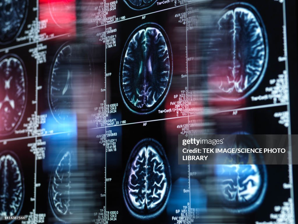 Alzheimer's and dementia research, conceptual image