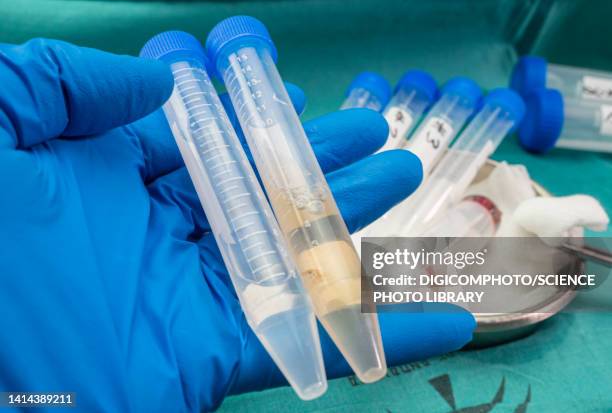 cerebrospinal fluid sample tubes - liquor stockfoto's en -beelden