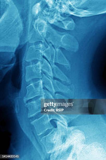Cervical osteoarthritis visualized by a sagittal x-ray of the neck.