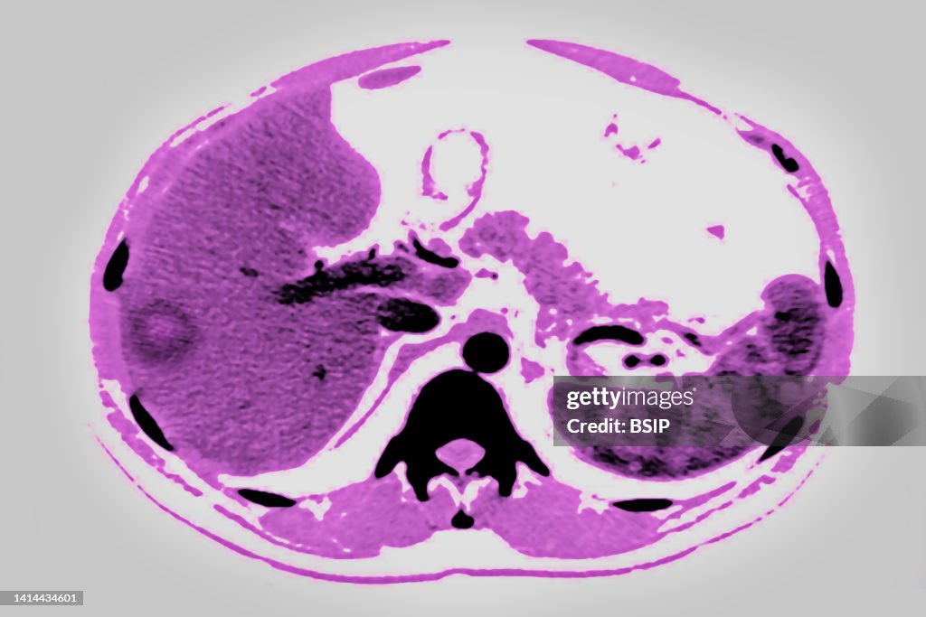 Lymphoreticulosis