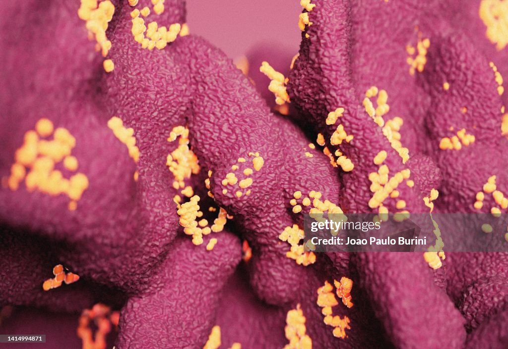 New Langya heni pavirus infection in human tissue