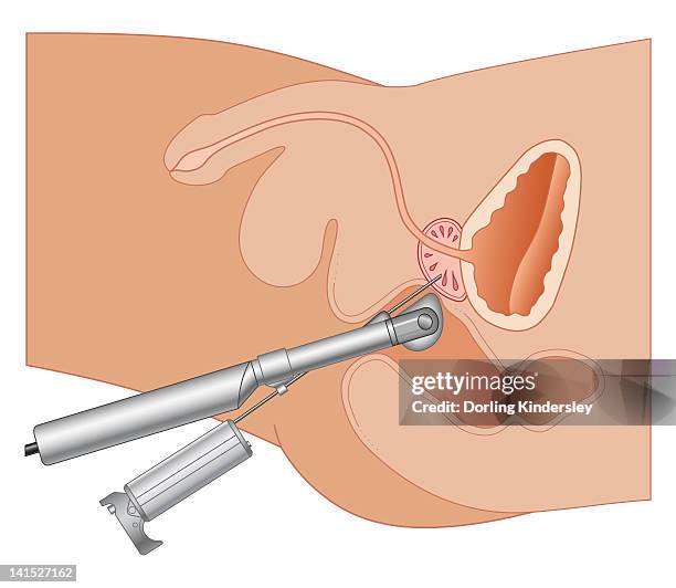 cross section biomedical illustration of prostate gland needle biopsy procedure - biopsy stock illustrations