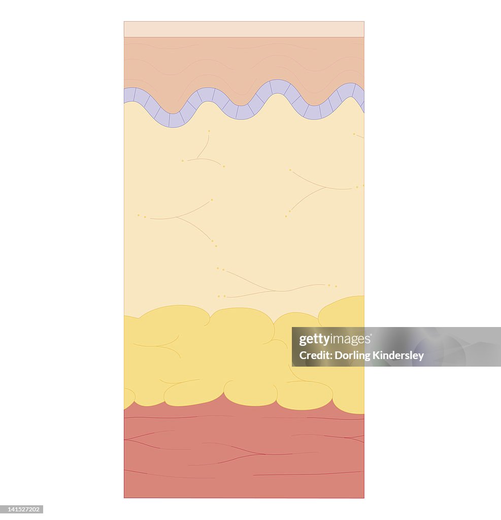 Significant Burn Cross Section Biomedical Illustration Of Degrees Of Severity Of Burns ...