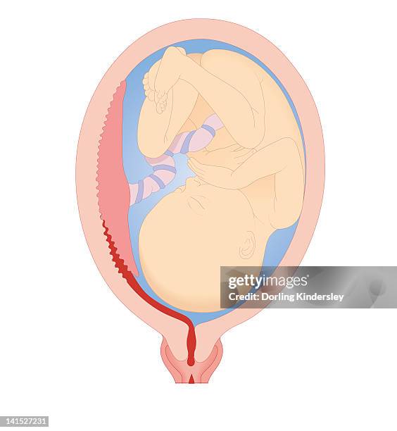 cross section biomedical illustration of revealed placental abruption - placenta 幅插畫檔、美工圖案、卡通及圖標