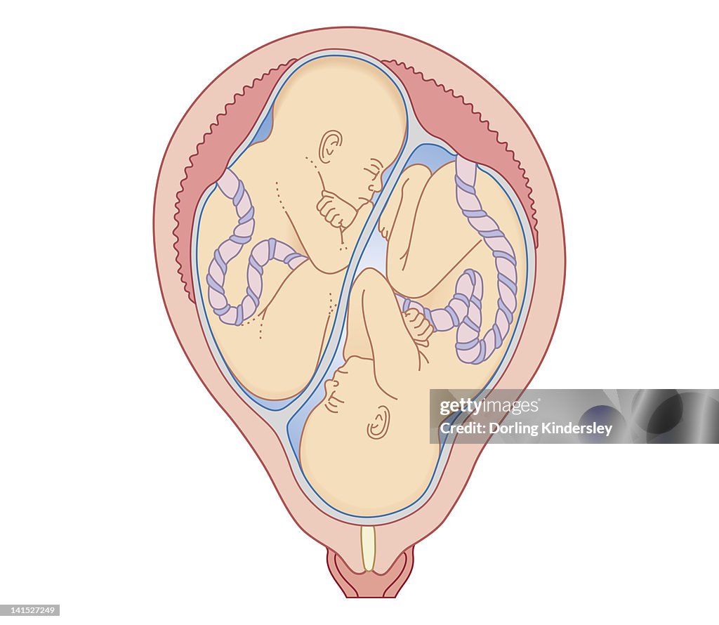 Cross section biomedical illustration of non identical twins in uterus with separate placentas