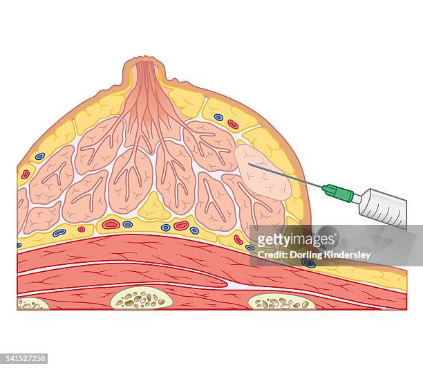 cross section biomedical illustration of fine needle aspiration of breast lump - brustwarze stock-grafiken, -clipart, -cartoons und -symbole