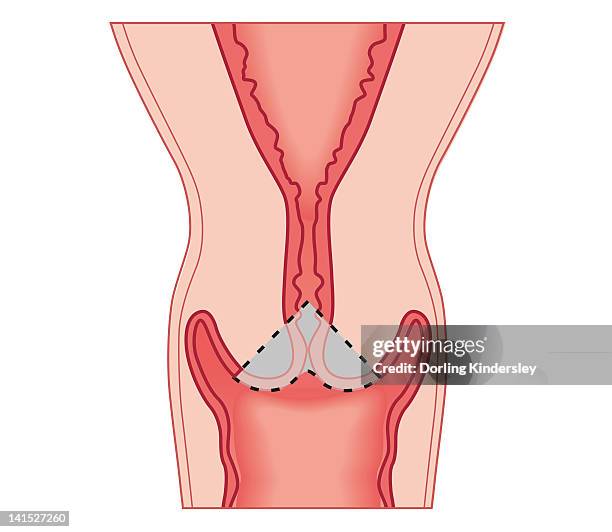 cross section biomedical illustration of cervical conization biopsy of cervical intraepithelial neoplasia - biopsy stock illustrations