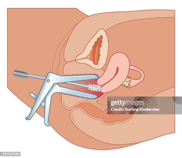 cross section biomedical illustration of papanicolaou test (cervical smear) using speculum - pap smear 幅插畫檔、美工圖案、卡通及圖標