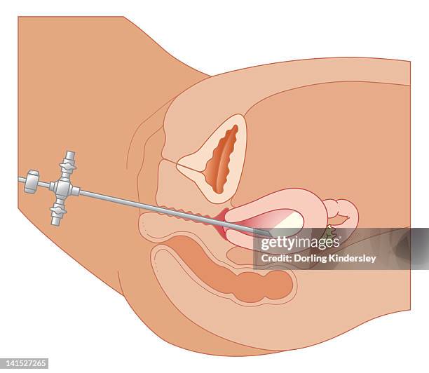 cross section biomedical illustration of hysteroscopy procedure using endoscope - intimzone stock-grafiken, -clipart, -cartoons und -symbole