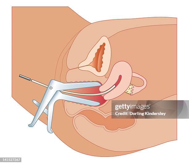 cross section biomedical illustration of endometrial biopsy using novak curette - biopsy stock illustrations