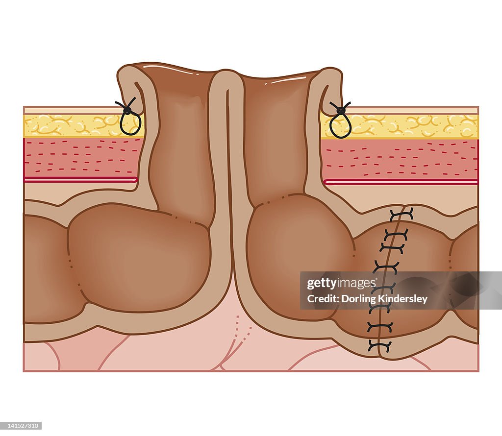 Cross section biomedical illustration of temporary colostomy