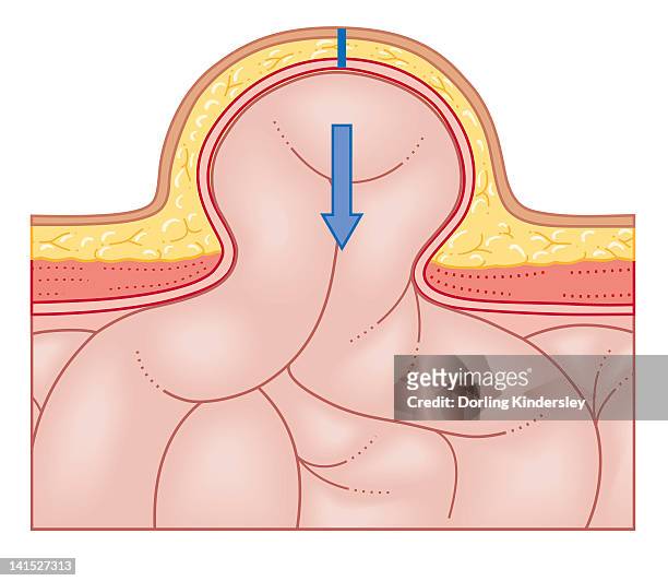 cross section biomedical illustration of hernia repair and site of incision to uncover the hernia - hernia stock illustrations