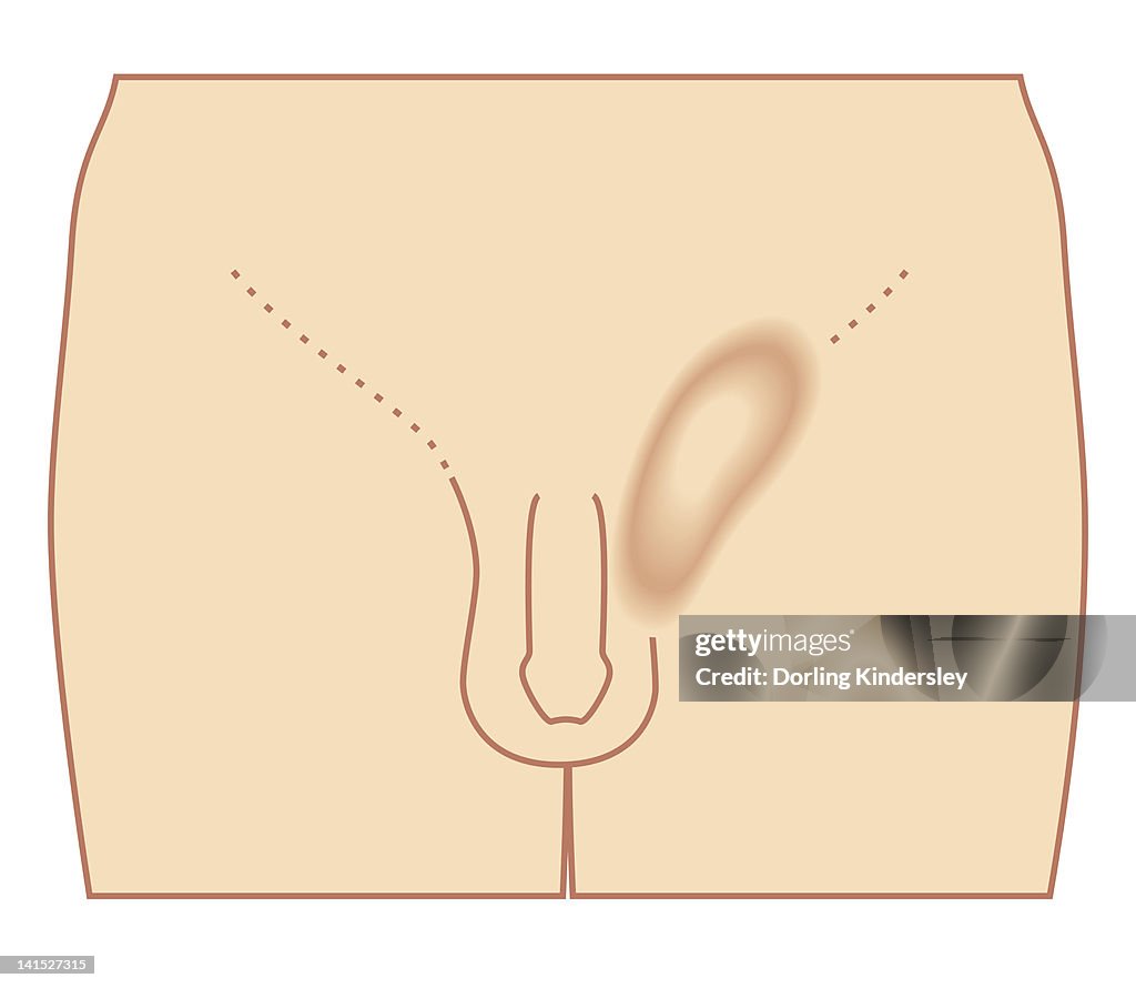 Cross section biomedical illustration of inguinal hernia in male