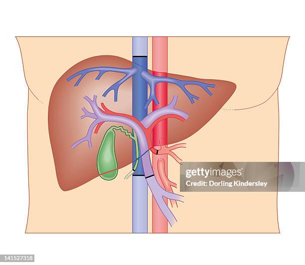 cross section biomedical illustration of liver transplant procedure - network operations stock illustrations