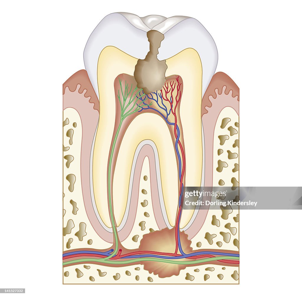 Cross Section Biomedical Illustration Of Pulp And Root Abscess In Molar ...