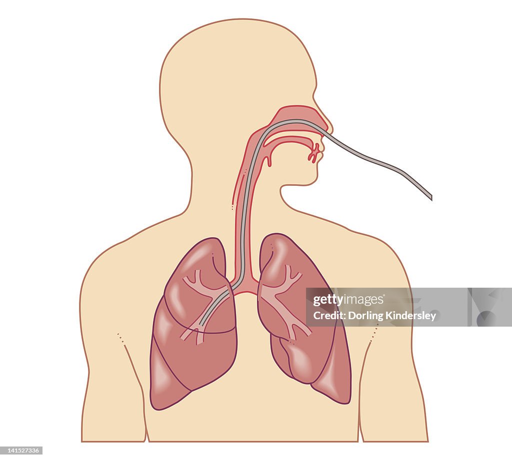 Cross section biomedical illustration of route of bronchoscope inserted through nose