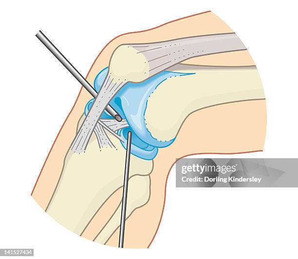 cross section biomedical illustration of inside the knee joint during rigid endoscopy procedure - 内視鏡点のイラスト素材／クリップアート素材／マンガ素材／アイコン素材