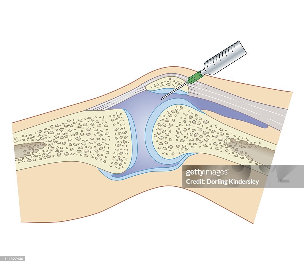 Cross Section Biomedical Illustration Of Removing Synovial Fluid From cross-section-biomedical-illustration-of-removing-synovial-fluid-from