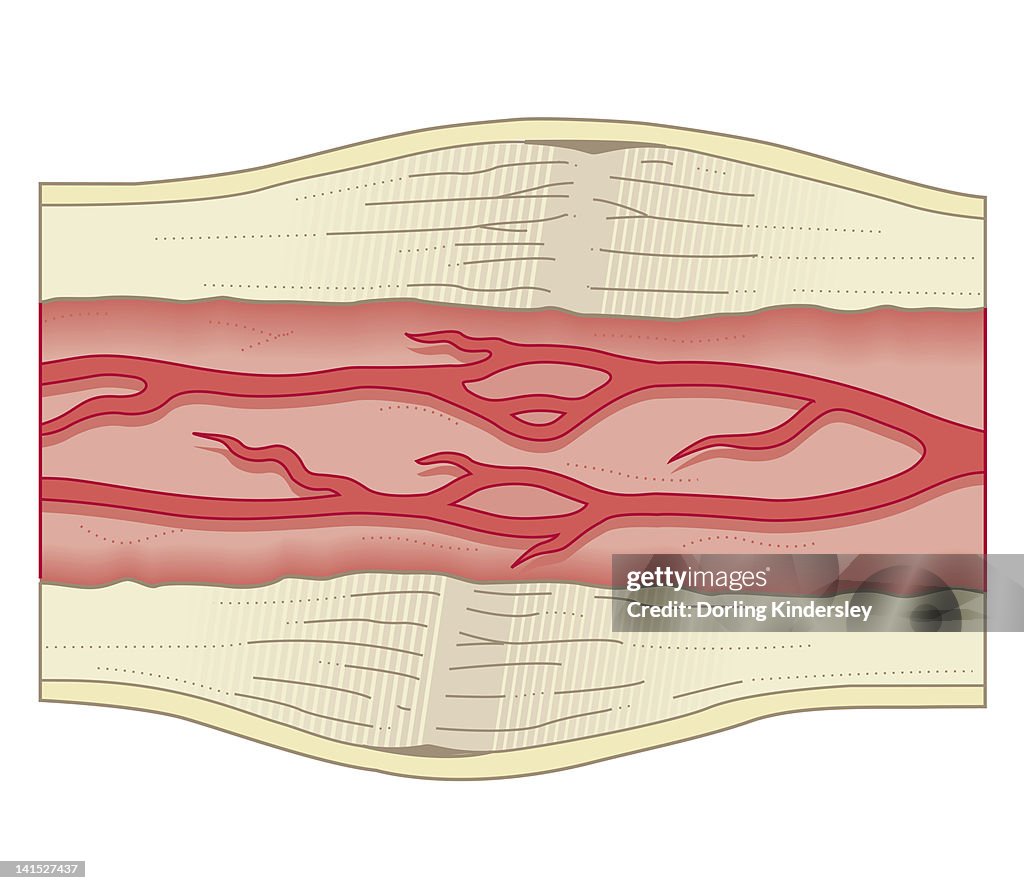 Cross section biomedical illustration of bone repairing itself with dense, compact bone gradually replacing the callus, and blood vessel regrowth