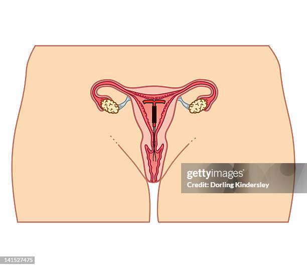 bildbanksillustrationer, clip art samt tecknat material och ikoner med cross section biomedical illustration of intrauterine device (iud) in position - äggledare