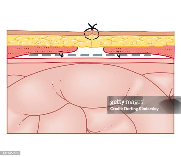 ilustraciones, imágenes clip art, dibujos animados e iconos de stock de cross section biomedical illustration of hernia repair using synthetic mesh - hernia mesh