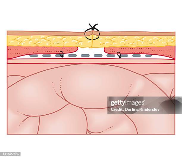 cross section biomedical illustration of hernia repair using synthetic mesh - hernia mesh stock illustrations