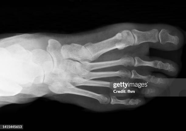 x-ray image of a human feet - broken heel stock-fotos und bilder