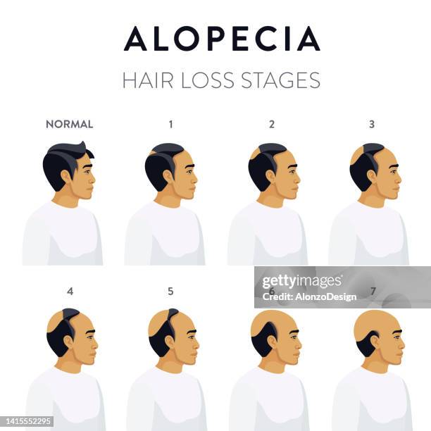 alopecia. hair loss stages. - scalp stock illustrations